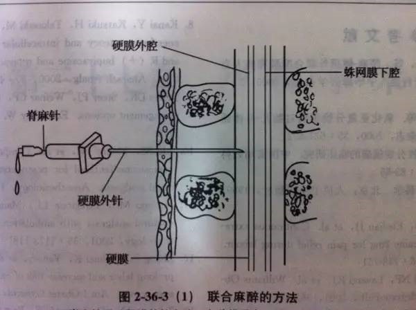 孕傻,剖腹產(chǎn)手術(shù),腰麻